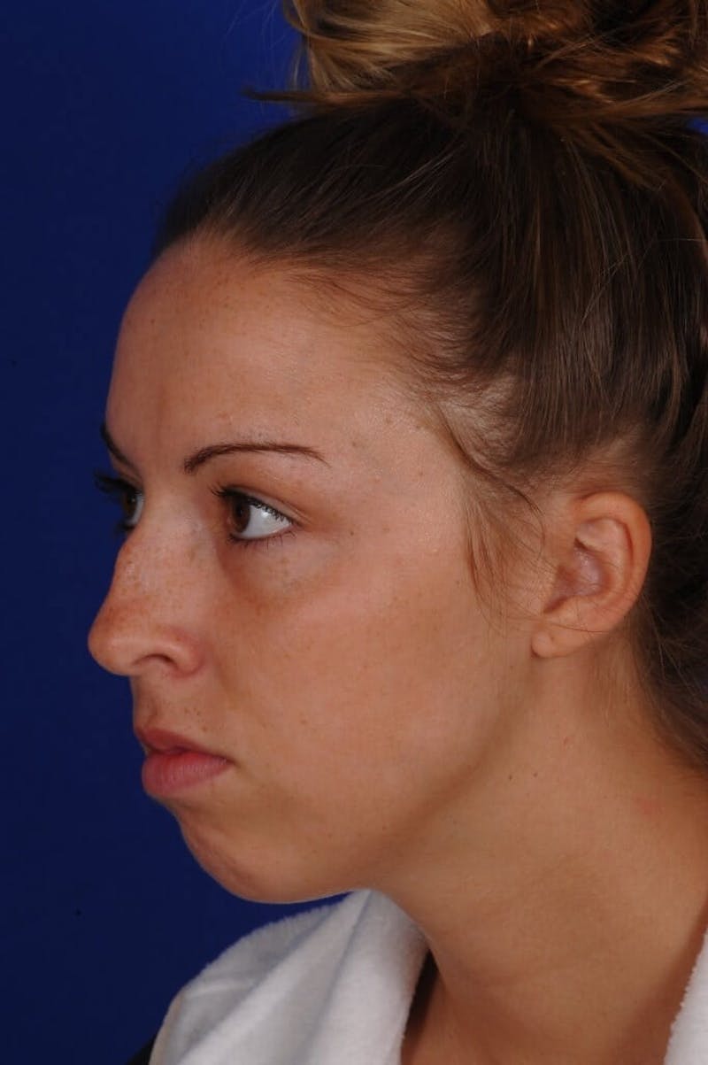 Septoplasty Before & After Gallery - Patient 316791 - Image 3
