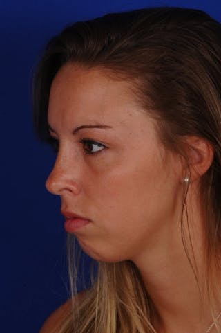 Septoplasty Before & After Gallery - Patient 316791 - Image 4