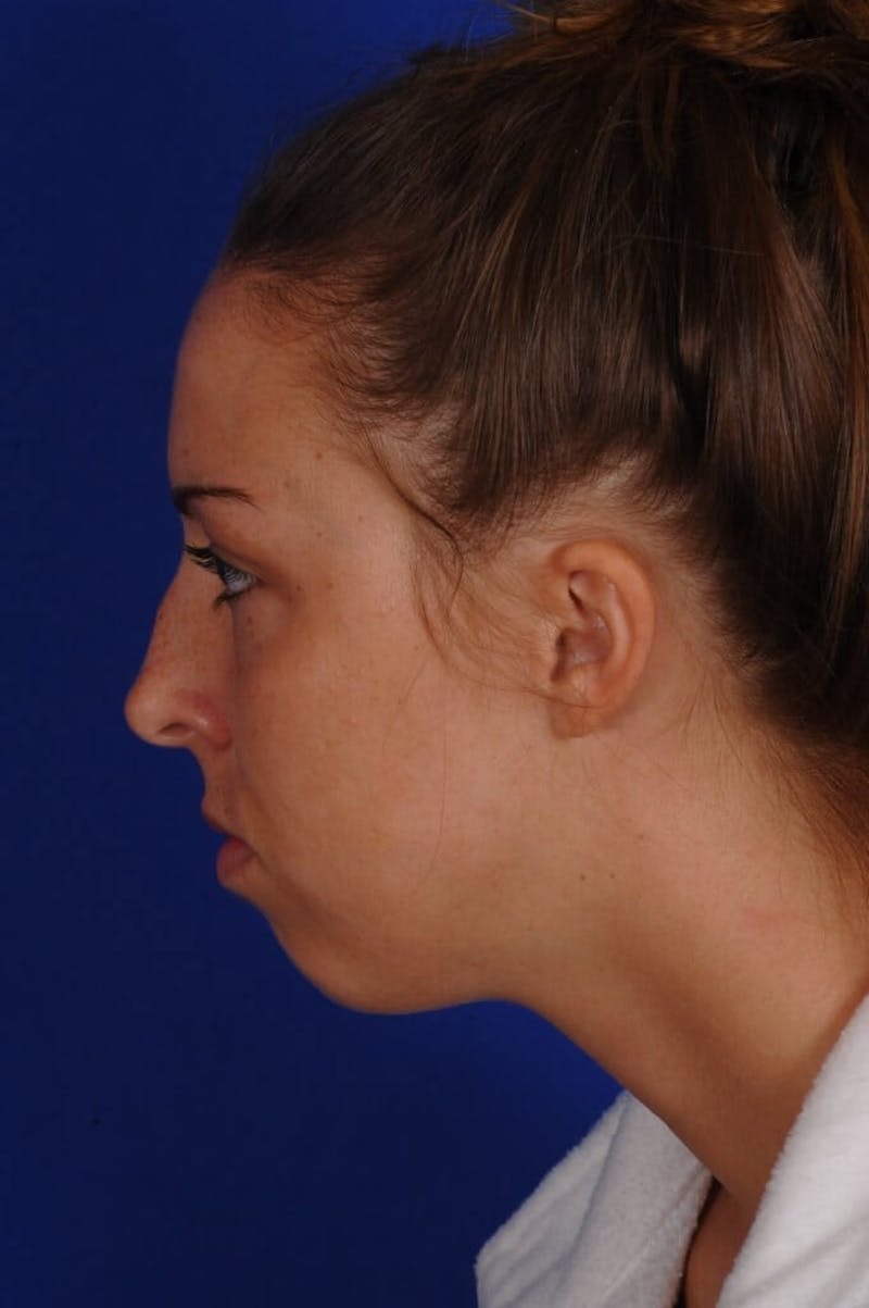 Septoplasty Before & After Gallery - Patient 316791 - Image 5