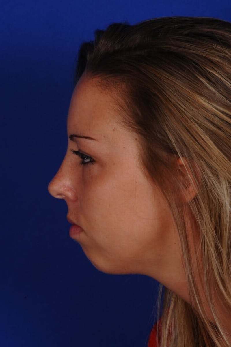 Septoplasty Before & After Gallery - Patient 316791 - Image 6