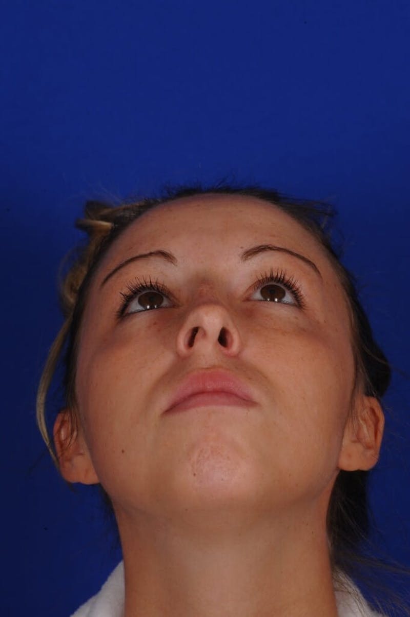 Septoplasty Before & After Gallery - Patient 316791 - Image 7
