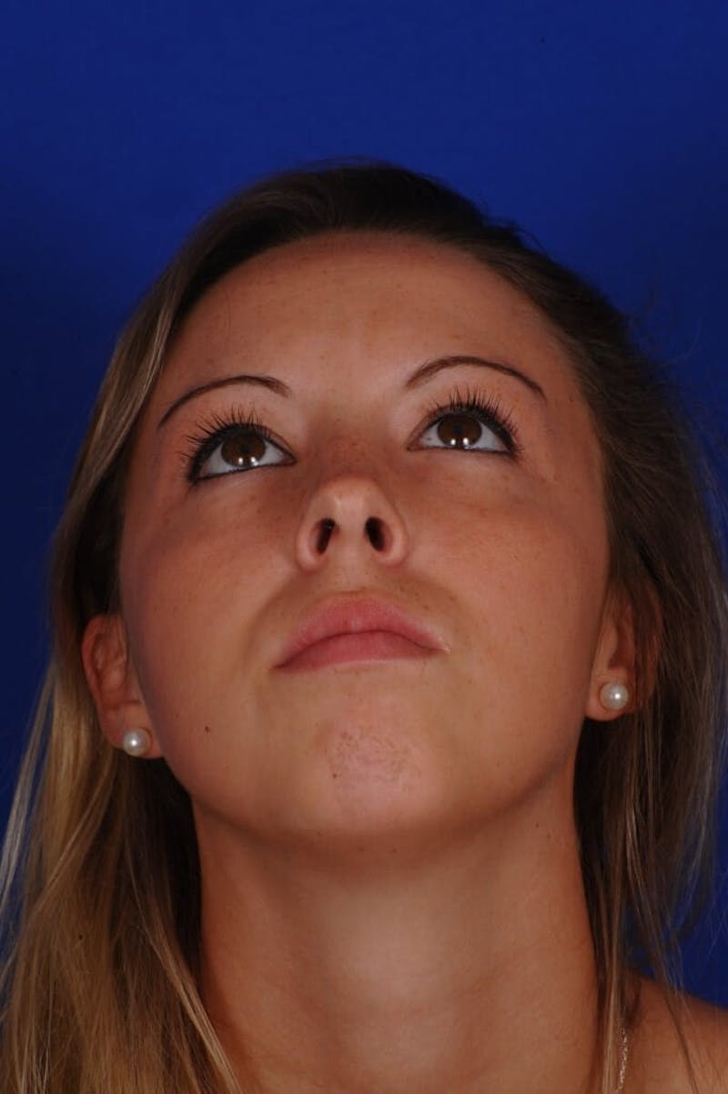 Septoplasty Before & After Gallery - Patient 316791 - Image 8