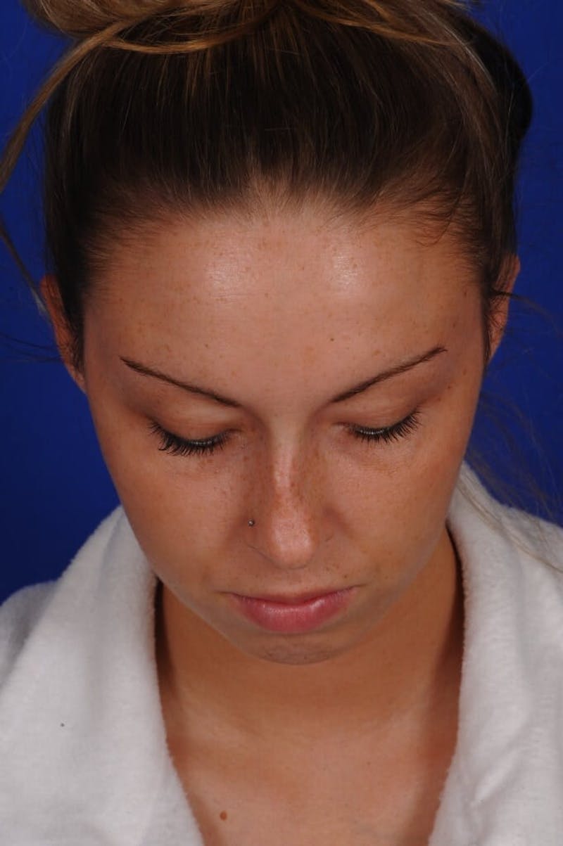 Septoplasty Before & After Gallery - Patient 316791 - Image 9