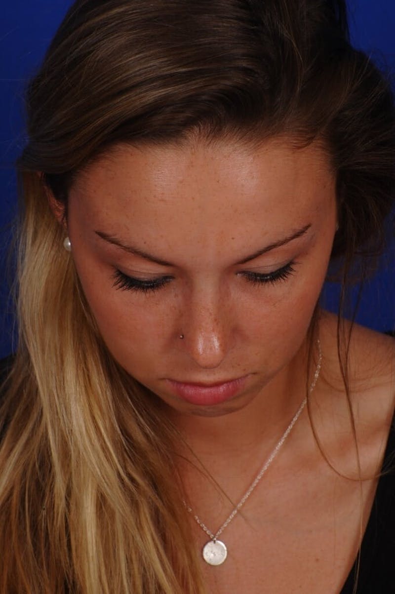 Septoplasty Before & After Gallery - Patient 316791 - Image 10
