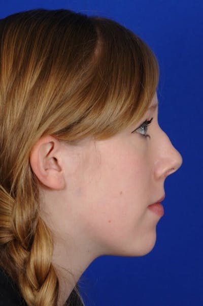 Septoplasty Before & After Gallery - Patient 381956 - Image 1