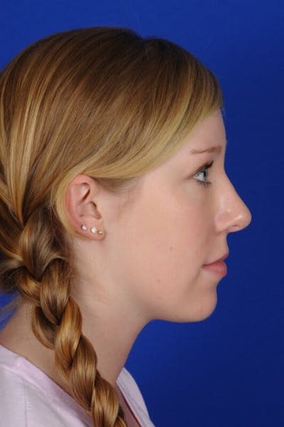 Septoplasty Before & After Gallery - Patient 381956 - Image 2