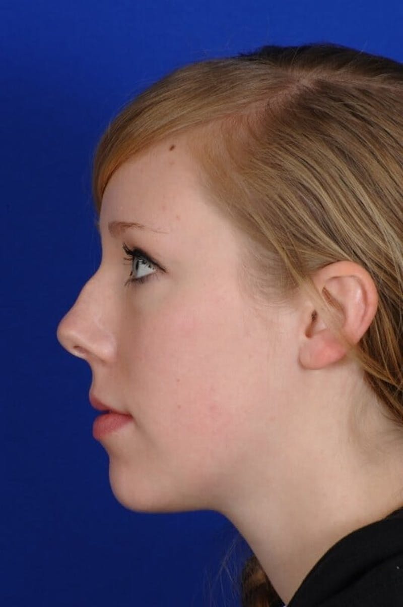Septoplasty Before & After Gallery - Patient 381956 - Image 3