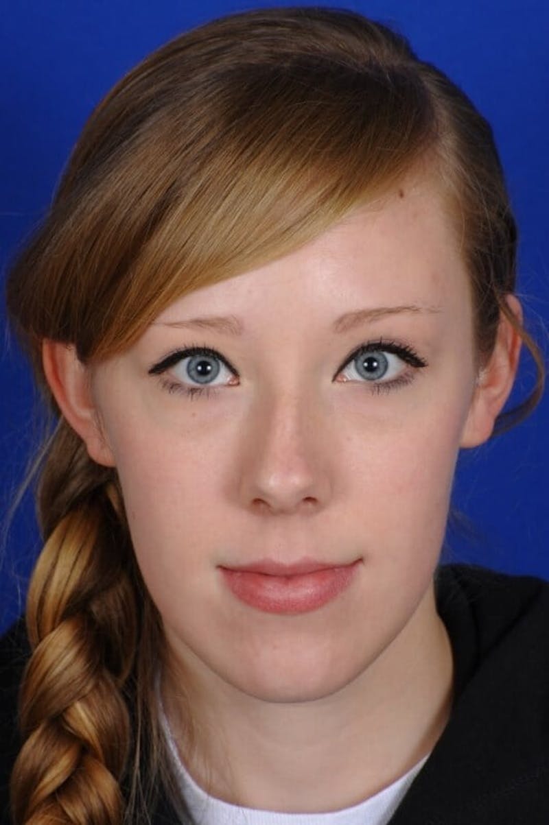 Septoplasty Before & After Gallery - Patient 381956 - Image 5
