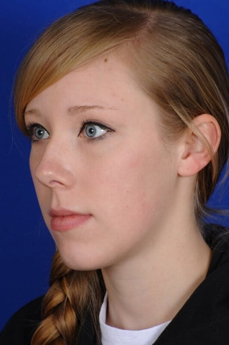 Septoplasty Before & After Gallery - Patient 381956 - Image 7