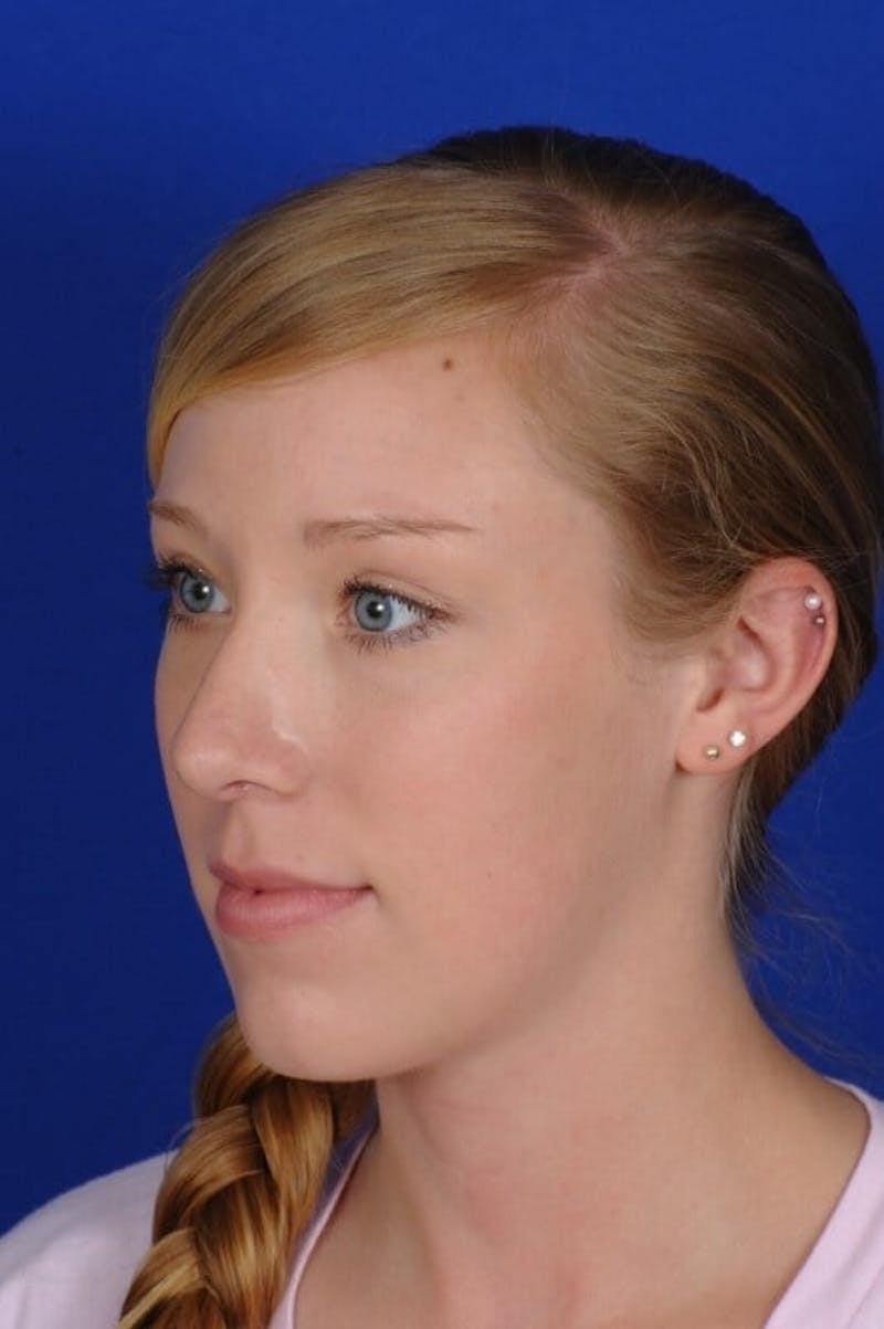 Septoplasty Before & After Gallery - Patient 381956 - Image 8