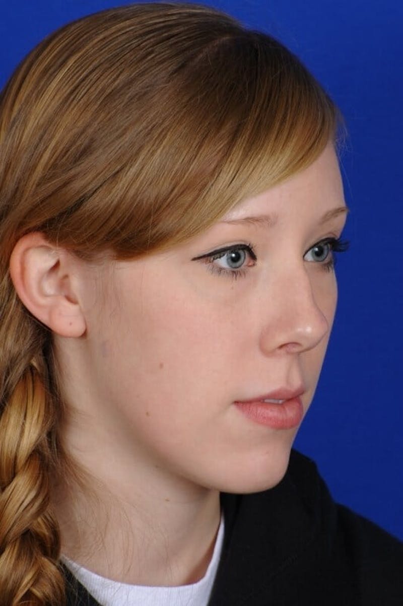 Septoplasty Before & After Gallery - Patient 381956 - Image 9