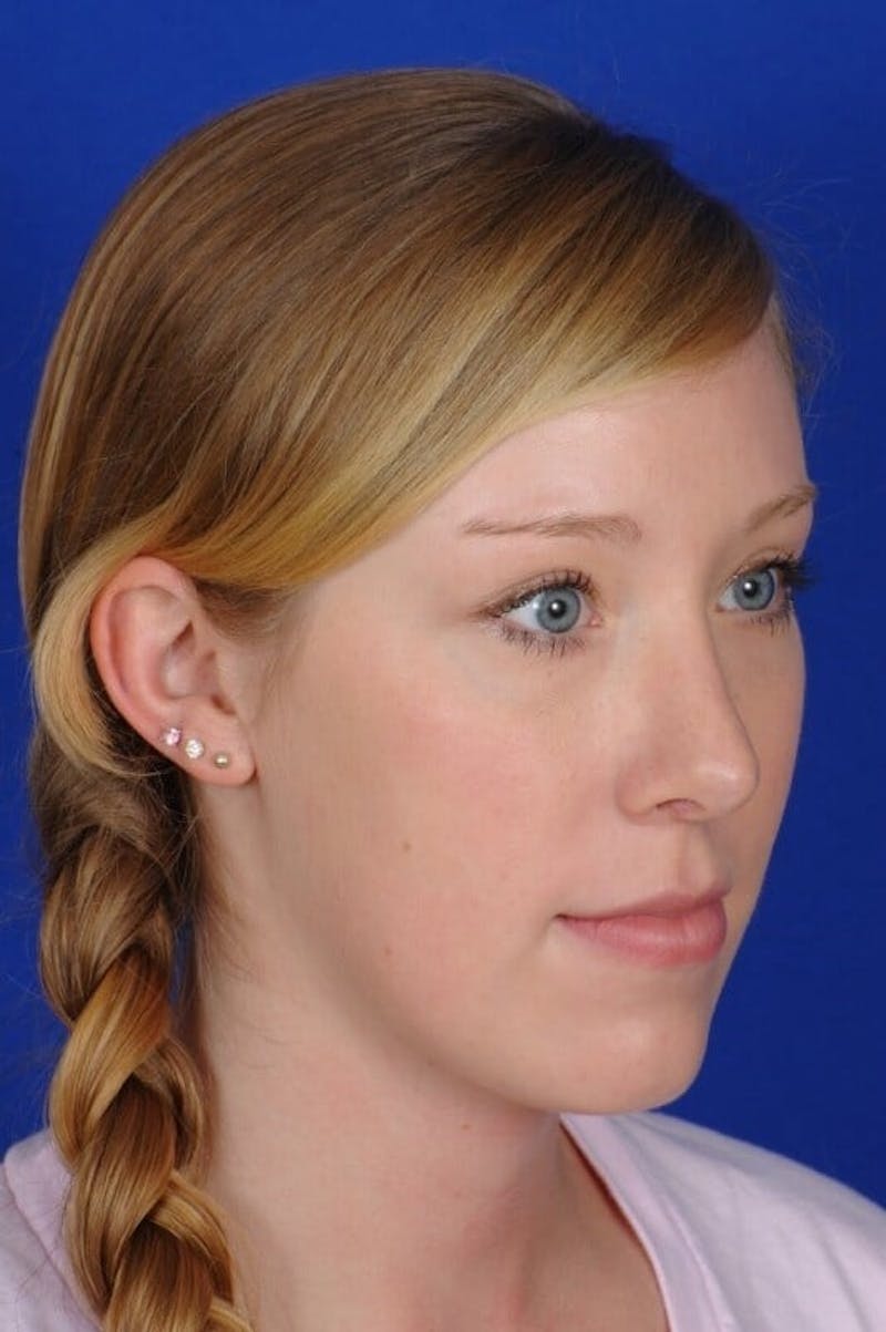 Septoplasty Before & After Gallery - Patient 381956 - Image 10