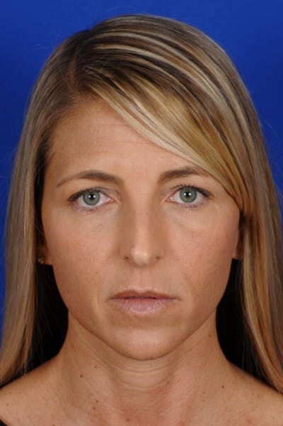 Septoplasty Before & After Gallery - Patient 355805 - Image 1