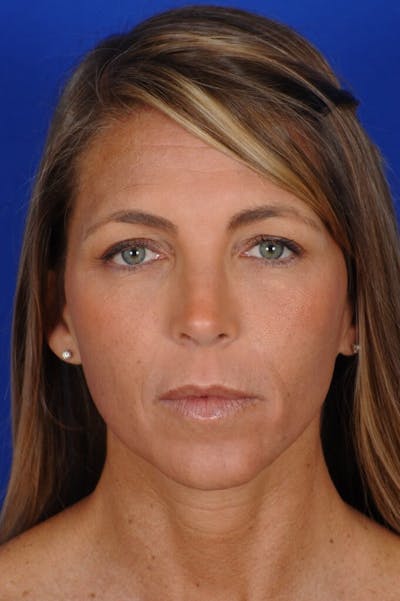 Septoplasty Before & After Gallery - Patient 355805 - Image 2