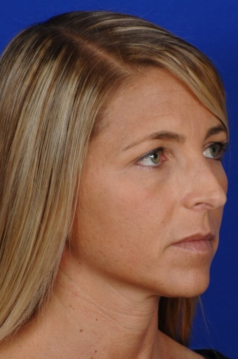Septoplasty Before & After Gallery - Patient 355805 - Image 7