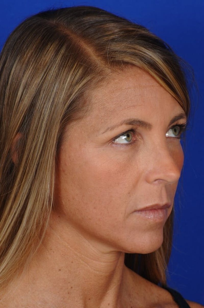 Septoplasty Before & After Gallery - Patient 355805 - Image 8