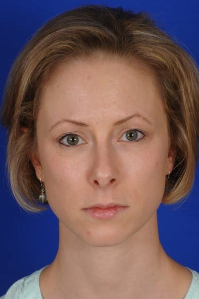 Septoplasty Before & After Gallery - Patient 104211 - Image 1