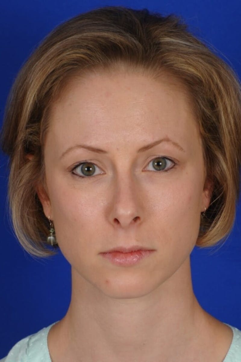 Septoplasty Before & After Gallery - Patient 104211 - Image 1