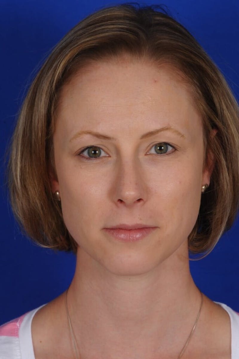Septoplasty Before & After Gallery - Patient 104211 - Image 2