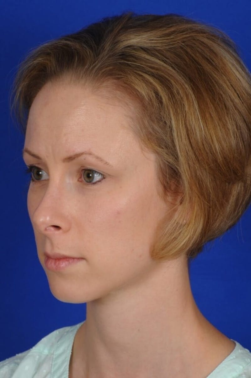 Septoplasty Before & After Gallery - Patient 104211 - Image 3
