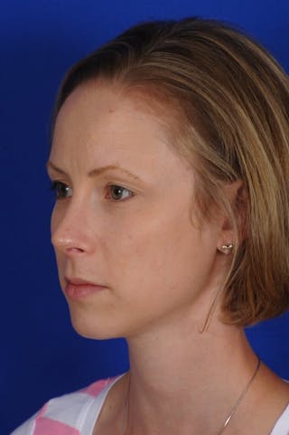 Septoplasty Before & After Gallery - Patient 104211 - Image 4