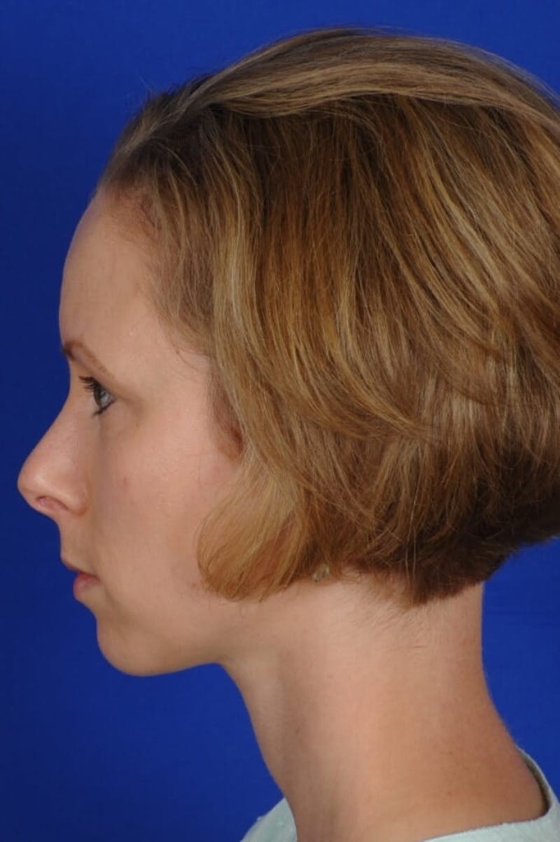 Septoplasty Before & After Gallery - Patient 104211 - Image 5