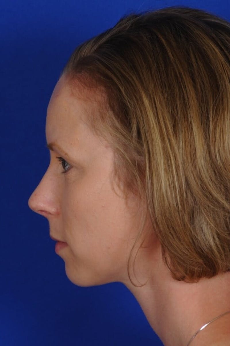 Septoplasty Before & After Gallery - Patient 104211 - Image 6
