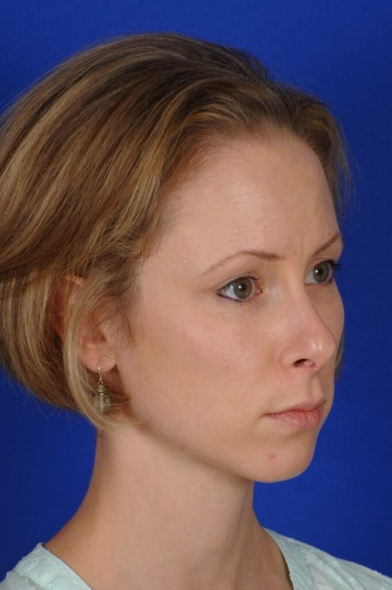 Septoplasty Before & After Gallery - Patient 104211 - Image 7