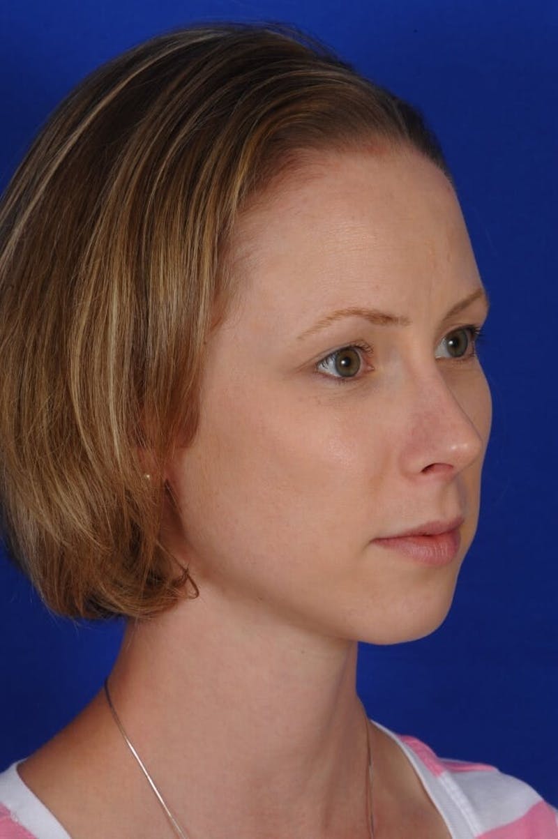 Septoplasty Before & After Gallery - Patient 104211 - Image 8
