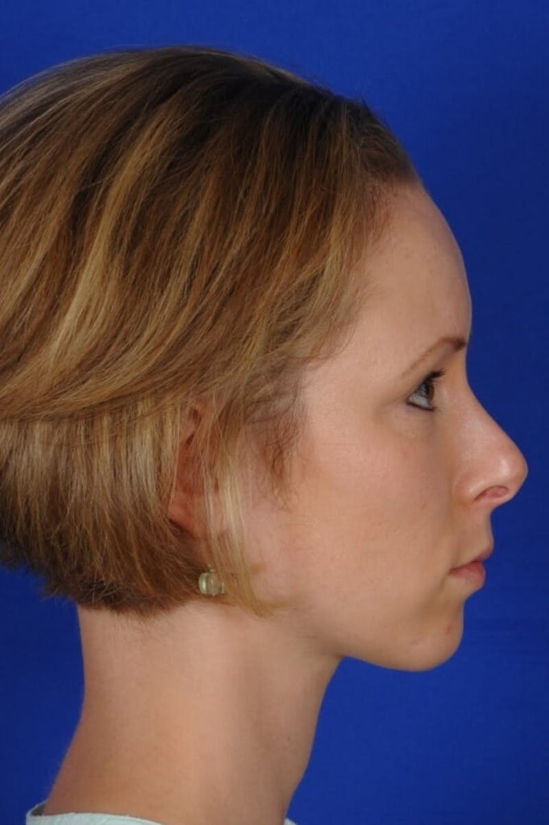 Septoplasty Before & After Gallery - Patient 104211 - Image 9
