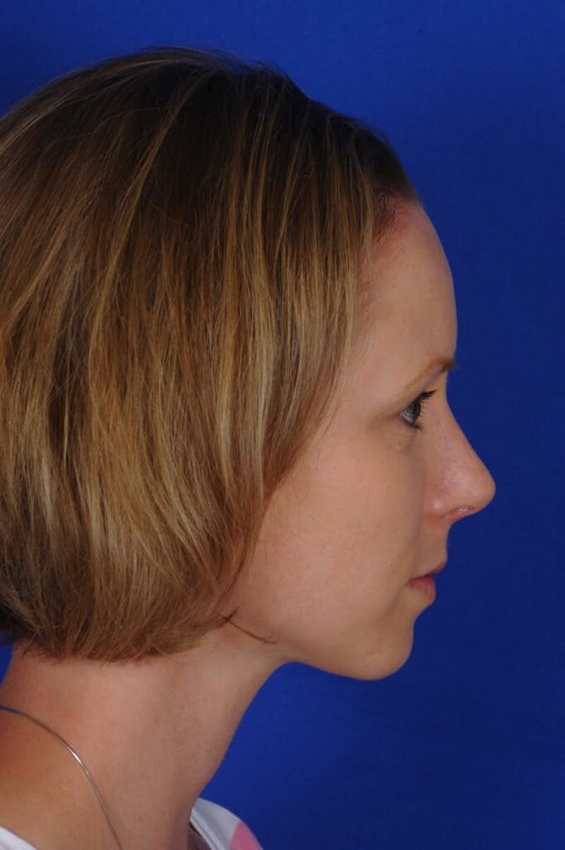 Septoplasty Before & After Gallery - Patient 104211 - Image 10