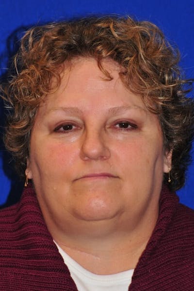 Septoplasty Before & After Gallery - Patient 231490 - Image 1
