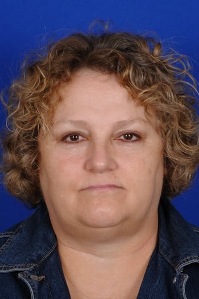 Septoplasty Before & After Gallery - Patient 231490 - Image 2