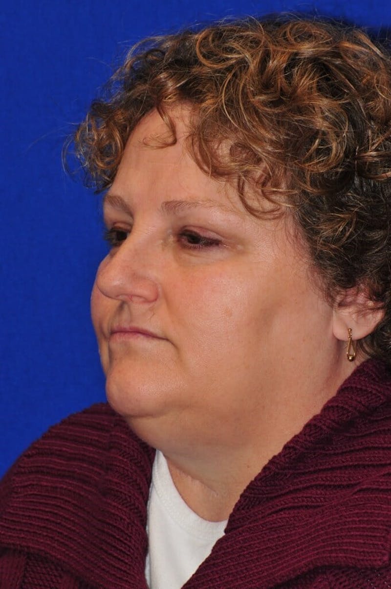 Septoplasty Before & After Gallery - Patient 231490 - Image 3