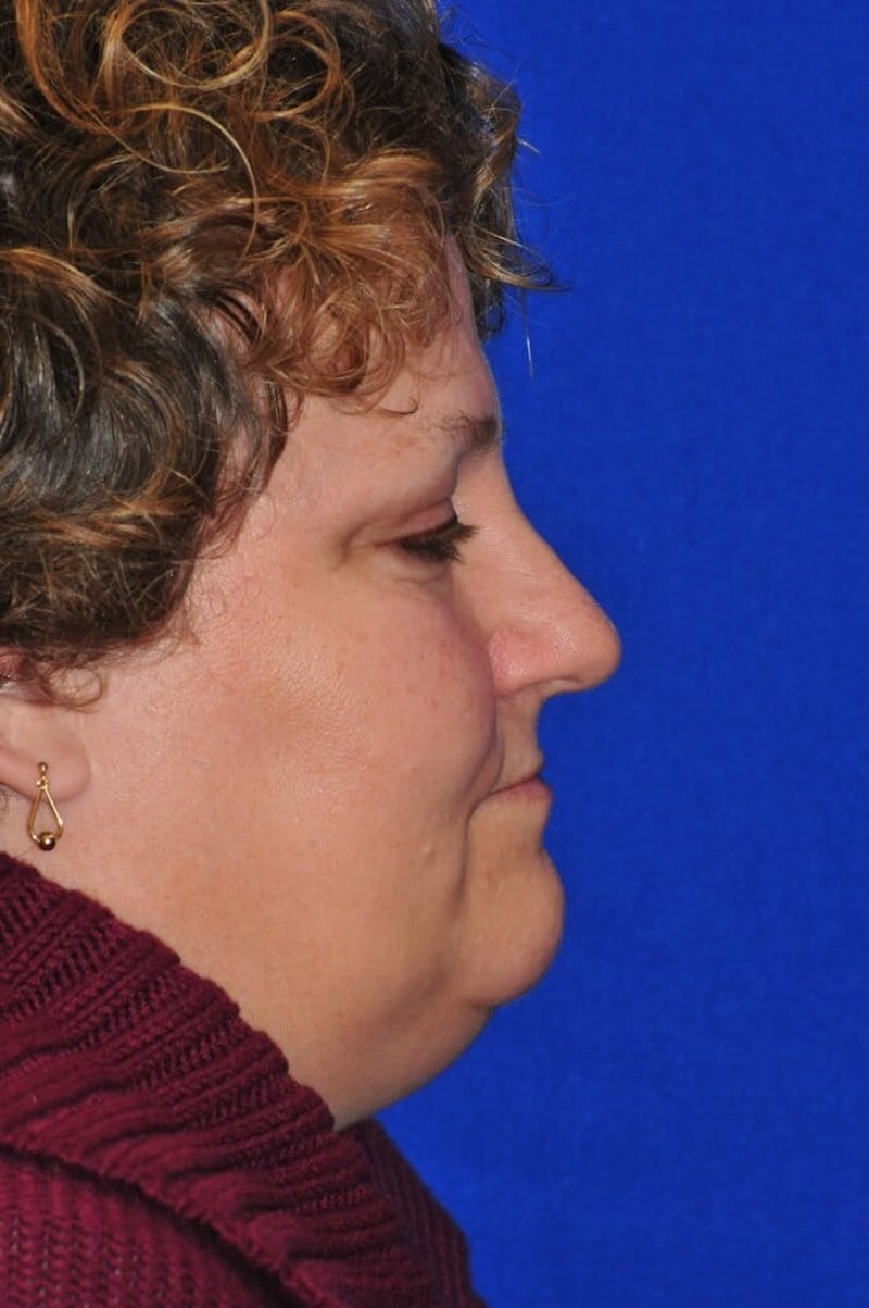 Septoplasty Before & After Gallery - Patient 231490 - Image 4