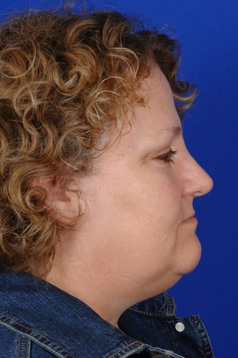 Septoplasty Before & After Gallery - Patient 231490 - Image 5