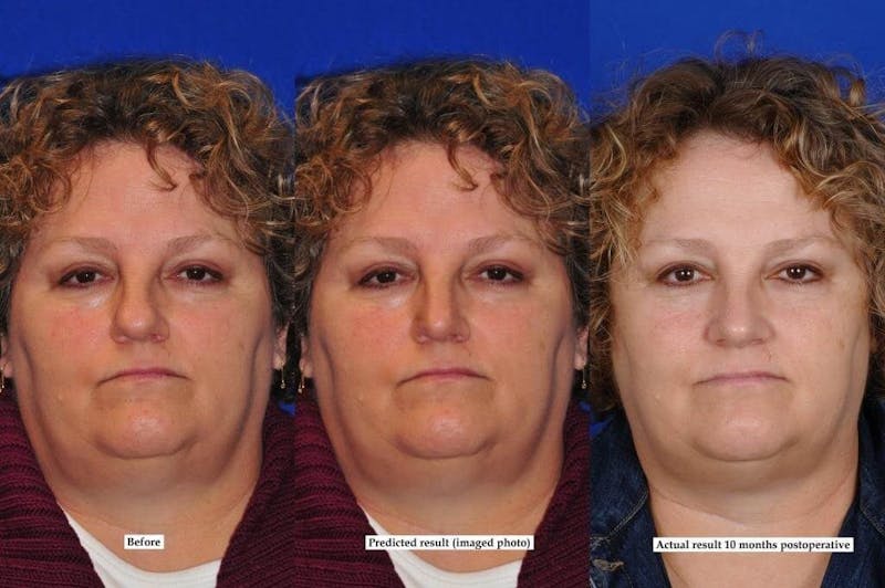 Septoplasty Before & After Gallery - Patient 231490 - Image 6