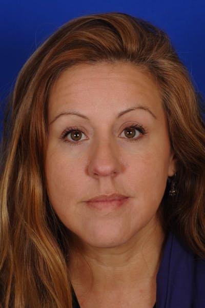 Septoplasty Before & After Gallery - Patient 625125 - Image 1