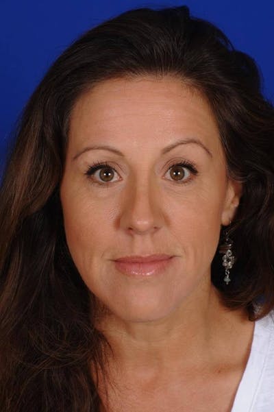 Septoplasty Before & After Gallery - Patient 625125 - Image 2