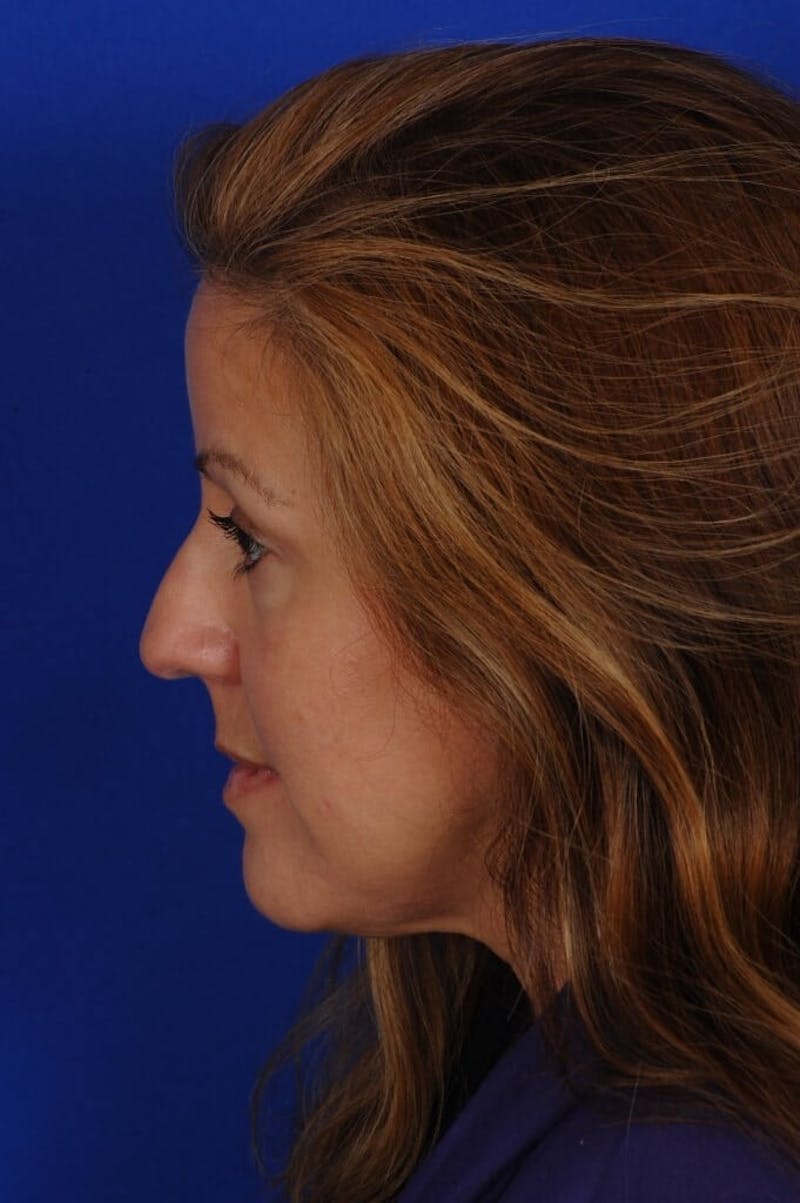Septoplasty Before & After Gallery - Patient 625125 - Image 3