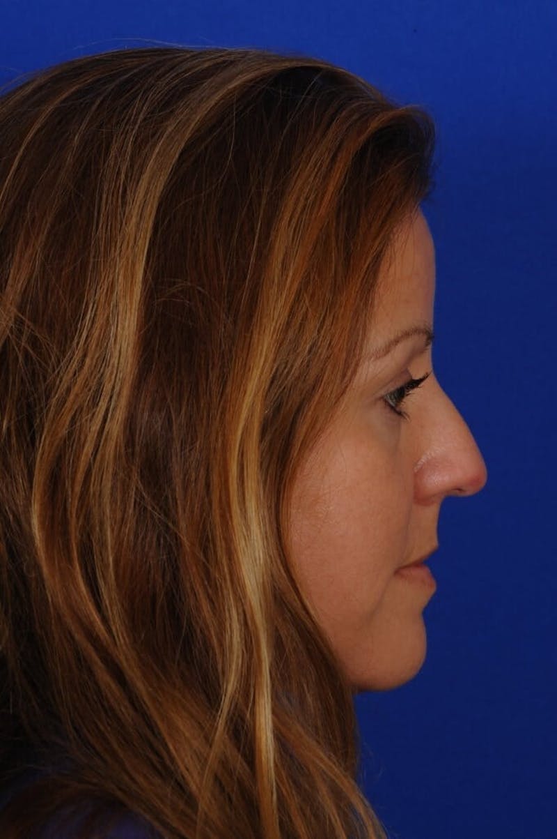 Septoplasty Before & After Gallery - Patient 625125 - Image 5