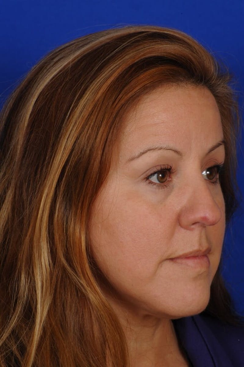 Septoplasty Before & After Gallery - Patient 625125 - Image 7