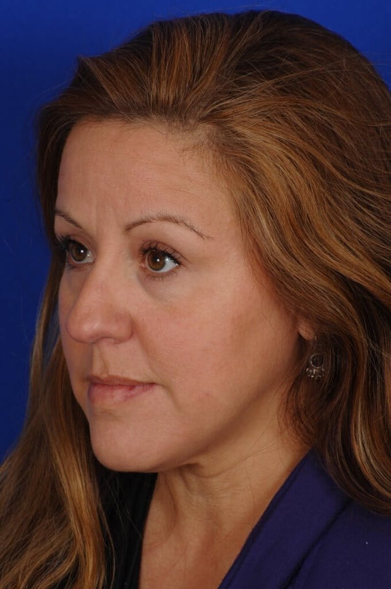 Septoplasty Before & After Gallery - Patient 625125 - Image 9