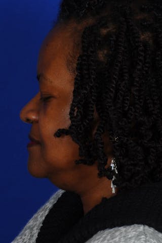 Septoplasty Before & After Gallery - Patient 140130 - Image 6