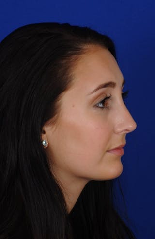 Septoplasty Before & After Gallery - Patient 291999 - Image 2