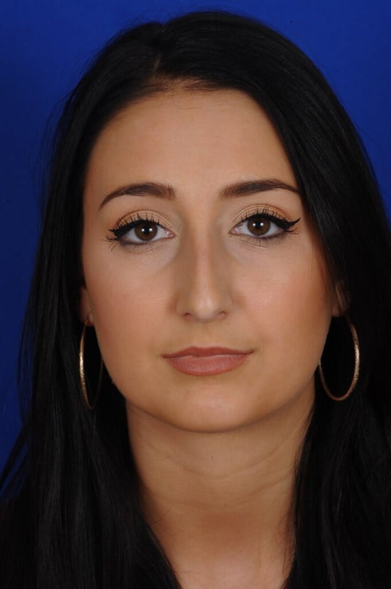 Septoplasty Before & After Gallery - Patient 291999 - Image 5