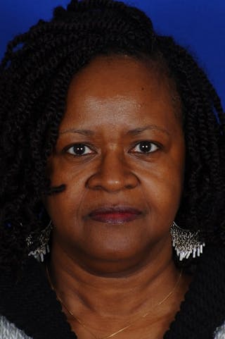 Septal Perforation Before & After Gallery - Patient 288611 - Image 2