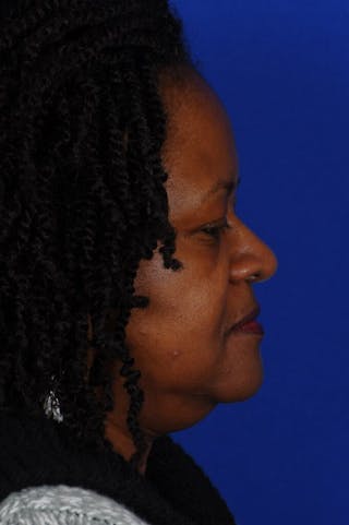 Septal Perforation Before & After Gallery - Patient 288611 - Image 4