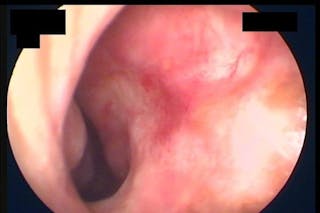 Septal Perforation Before & After Gallery - Patient 288611 - Image 12