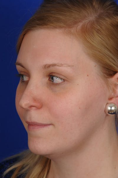 Revision Rhinoplasty Before & After Gallery - Patient 345881 - Image 1